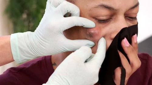 liter immunisering dart Watch Dr. Pimple Popper season 5 episode 2 streaming online | BetaSeries.com